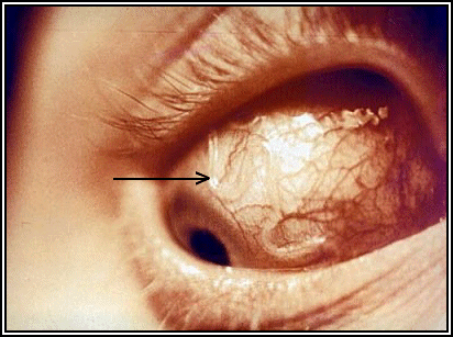 loa loa eye worm